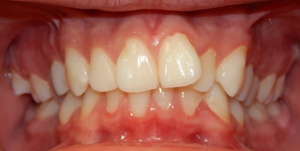 Orthodontics before